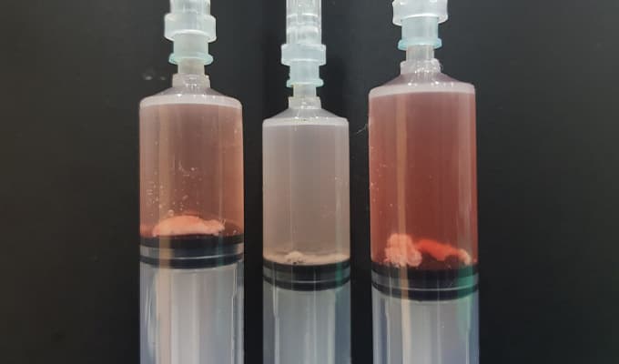 Calcific tendinitis treatment case 5 — before and after ultrasound