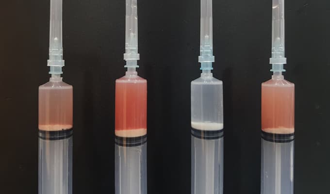 Calcific tendinitis treatment case 6 — before and after ultrasound